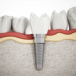 Dental implant post integrated into jawbone