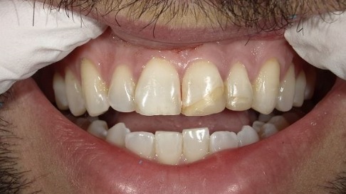 Discolored top front teeth