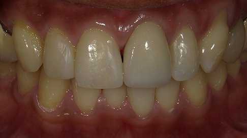 Healthy beautiful smile after dental restoration