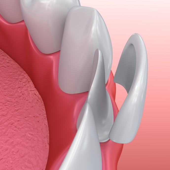 Animated smile during porcelain veneer cosmetic dentistry