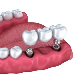 Animated dental implant supported fixed bridge placement