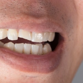 Smile with chipped front tooth