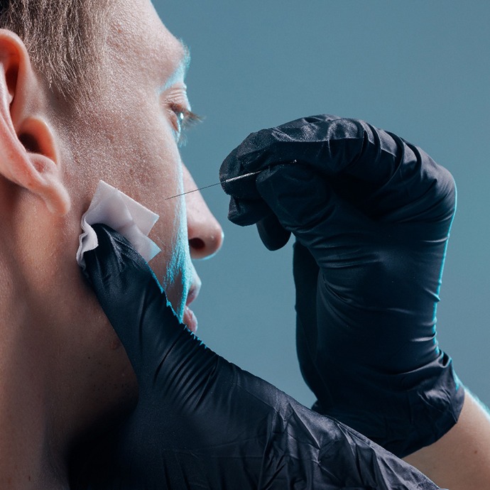 Facial dry needling