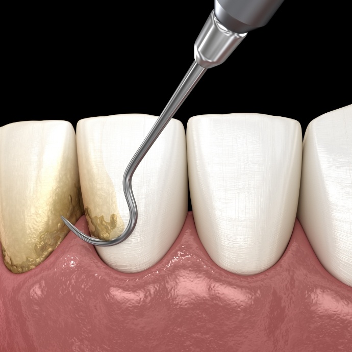 Animated smile during scaling and root planing gum disease treatment