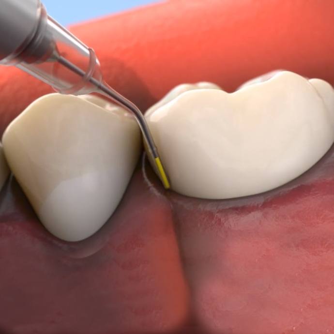 Animated smile during antibiotic therapy treatment