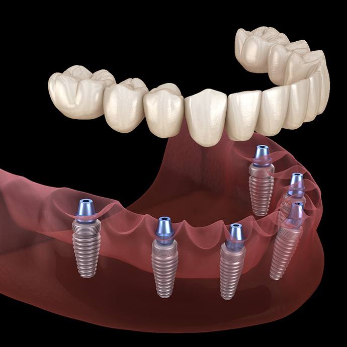 Digital illustration of implant dentures in Longmont 