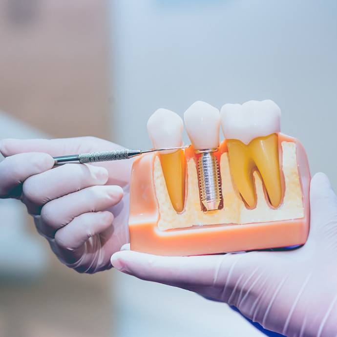 Dentist explaining how implant dentures in Longmont work