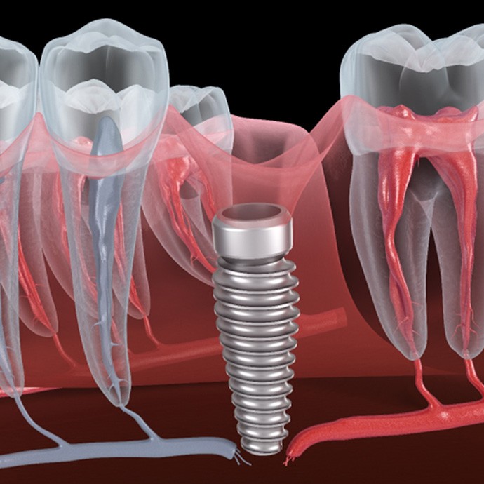 Illustration of a failed dental implant in Longmont, CO