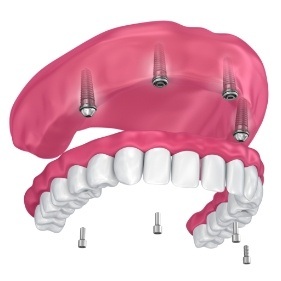 Digital illustration of an implant denture in Longmont