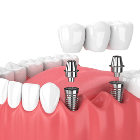 Digital illustration of a dental implant bridge in Longmont