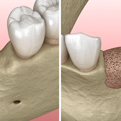 3d model of bone grafting