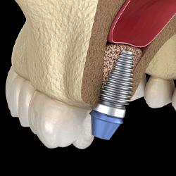 graphic of sinus lift