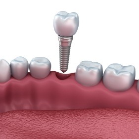 Digital illustration of a single tooth dental implant in Longmont