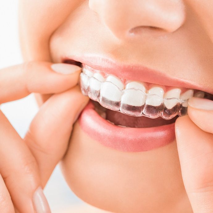 Closeup of patient wearing Invisalign in Longmont