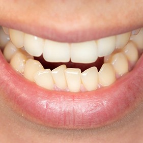 Closeup of patient with crooked teeth in Longmont before Invisalign