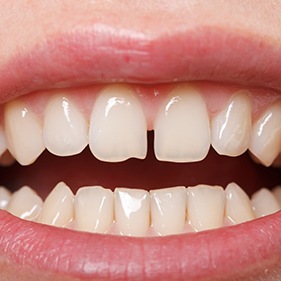 Closeup of patient with gap between front teeth in Longmont before Invisalign