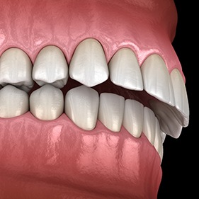 Digital illustration of overbite in Longmont before Invisalign