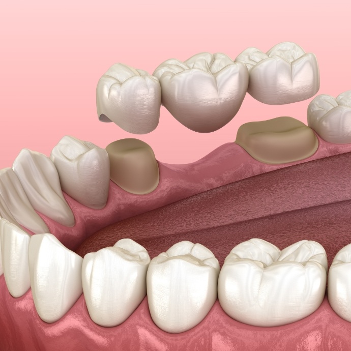 Animated smile with dental bridge to replace missing teeth