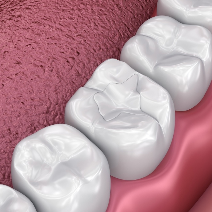 Animated smile with tooth colored filling after restorative dentistry