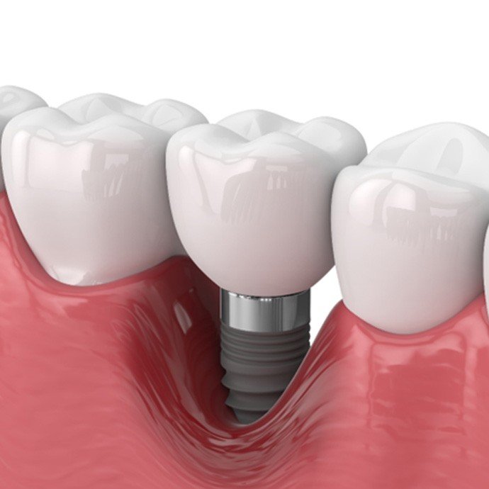 Illustration of peri-implantitis around a failed dental implant in Longmont, CO