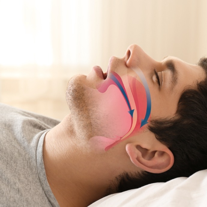 Man snoring with an animated airway over his facial profile