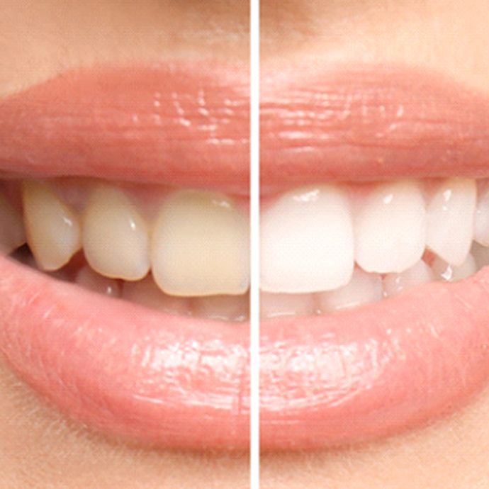 Before and after of teeth whitening in Longmont