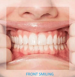 Close up of both rows of teeth