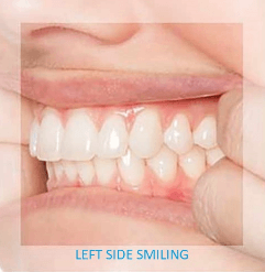 View of teeth from left side