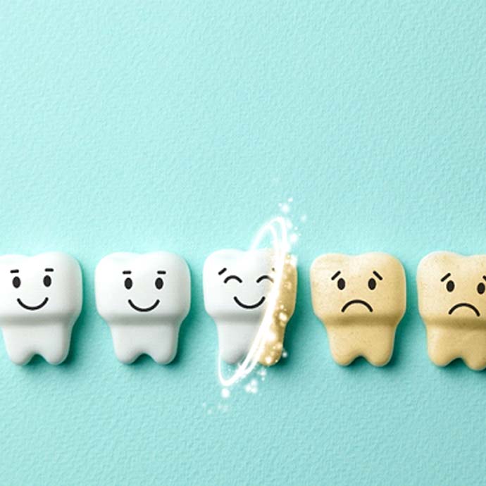 Illustration of teeth whitening in Longmont