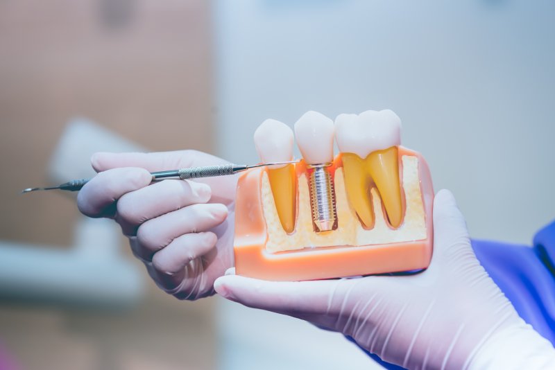 Dentist showing dental implants on model of teeth