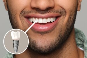 Man smiling with a dental implant