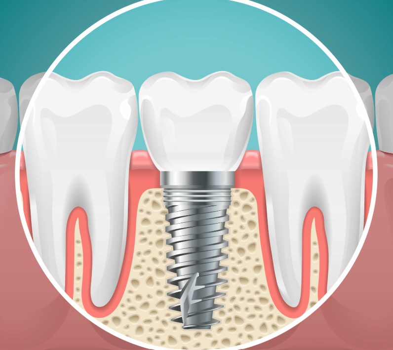 Illustrated cross section of a dental implant